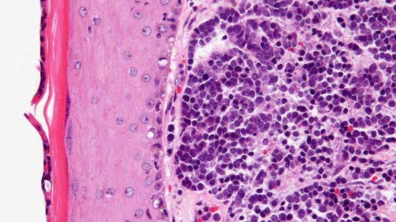 Very high magnification micrograph of Merkel cell carcinoma - WIkimedia Commons - Credits - Nephron, under CC-BY-SA 3.0 First-ever study in India investigates a rare type of cancer caused by a virus