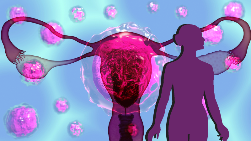 Five markers identified for diagnosing ovarian cancer